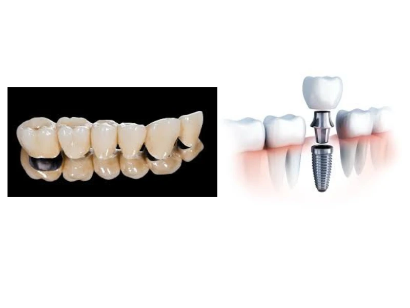 Dental bridge and dental implant