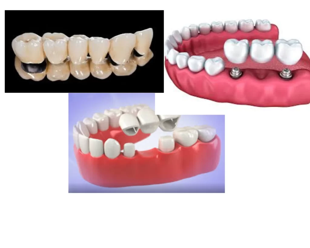 Dental bridge procedure